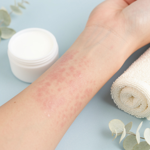Gros plan sur l’avant-bras d’une femme présentant de légères plaques sèches et rougeâtres d’eczéma, à côté d’un contenant neutre de crème hydratante et d’une serviette en coton.